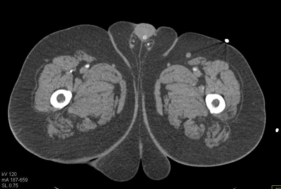 Acute Midaortic Occlusion - CTisus CT Scan