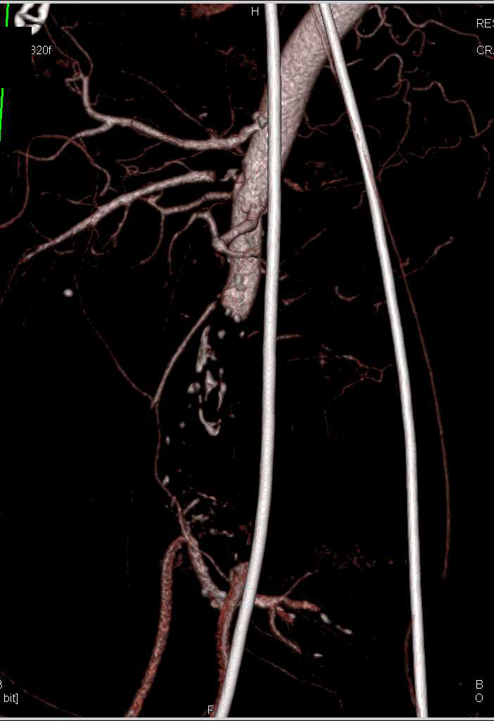 Acute Midaortic Occlusion with Collaterals - CTisus CT Scan