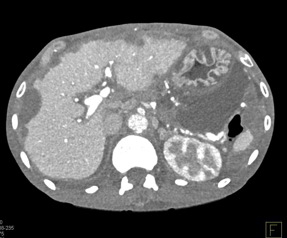 Endoleak of Aneurysm Repair in Patient with Scalloping on the Liver - CTisus CT Scan