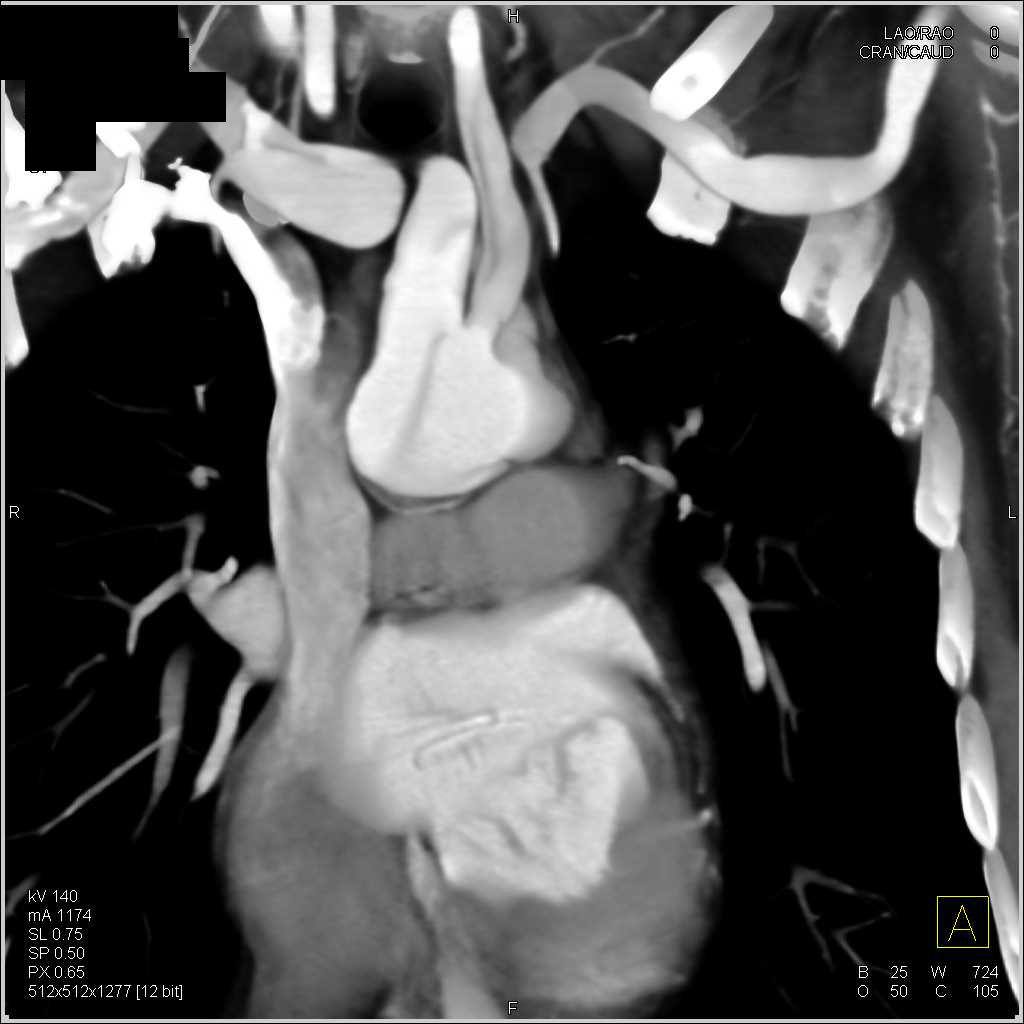 Type A Dissection Tracks into the Arch Vessels - CTisus CT Scan