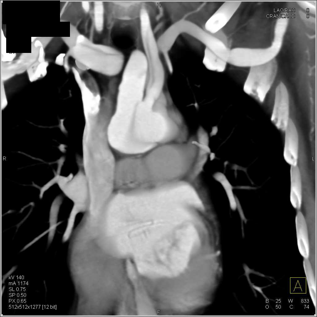 Type A Dissection Involves the Great Vessels off the Arch - CTisus CT Scan