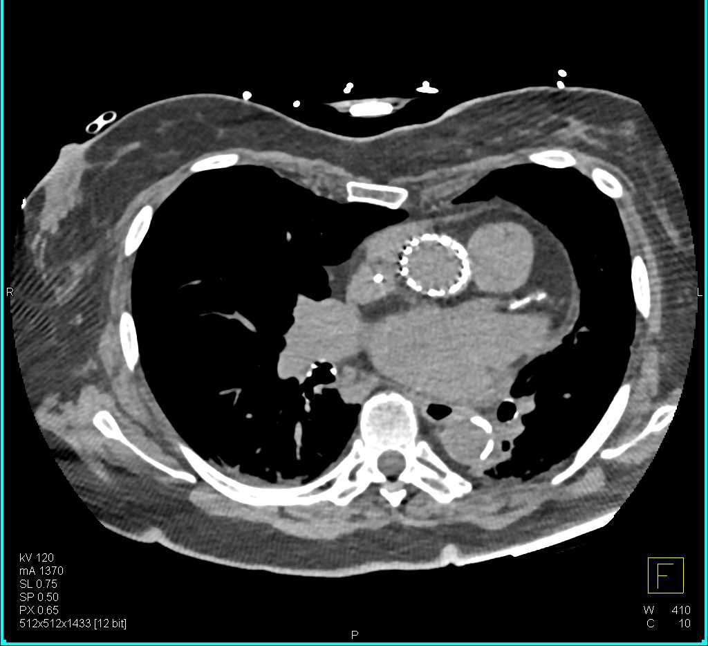 Transcatheter Aortic Valve Replacement (TAVR) Repair Ascending Aorta in 3D - CTisus CT Scan