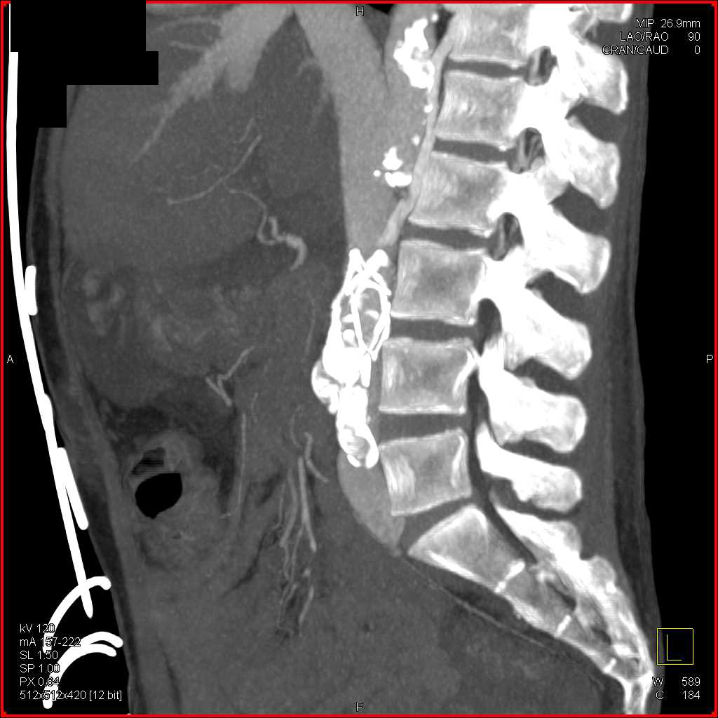 Endovascular Stent Repair - CTisus CT Scan