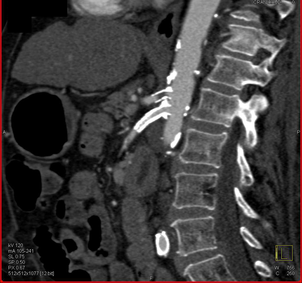 Near Occlusion of Proximal Celiac Artery Stent - CTisus CT Scan