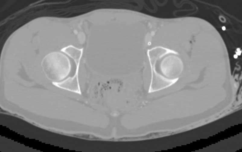 Vascular Injury Left Femoral Artery - CTisus CT Scan