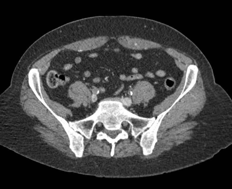 Occlusion of Infrarenal Abdominal Aorta - CTisus CT Scan