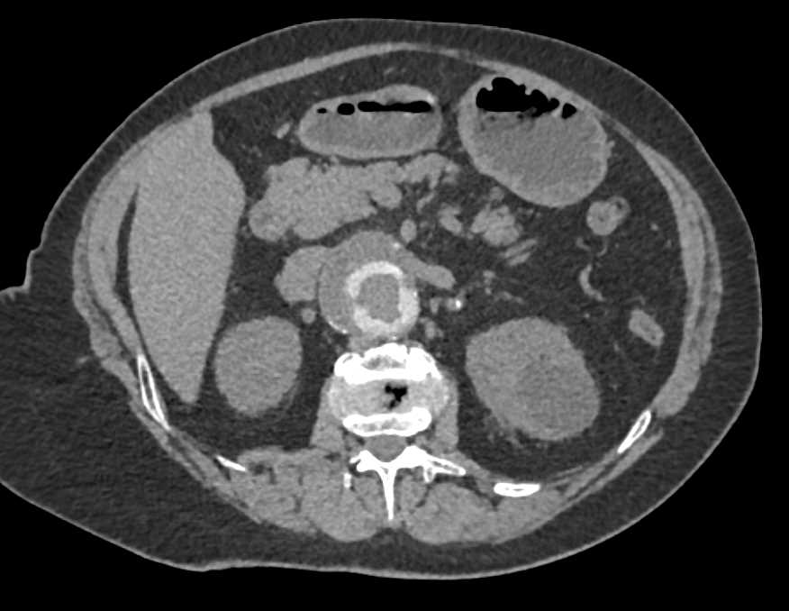 Ovation Endovascular Stent - CTisus CT Scan