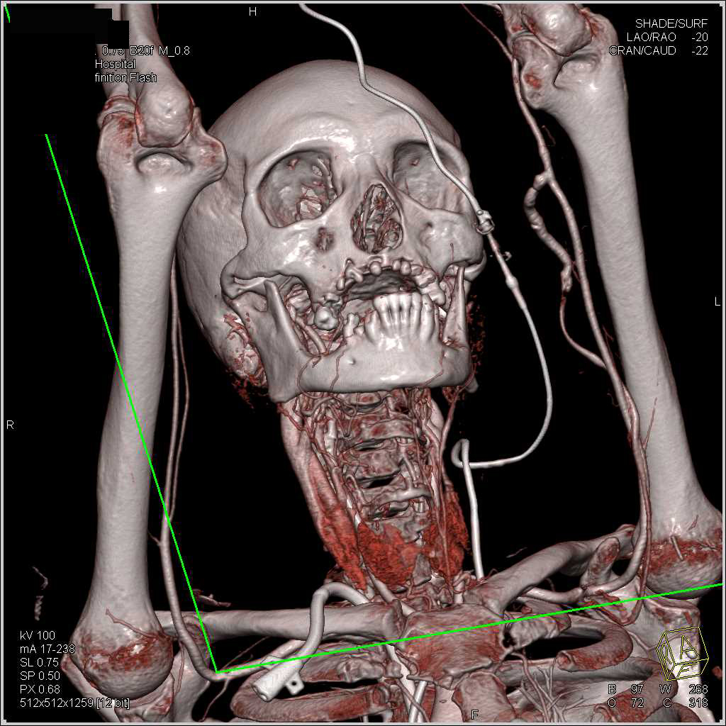 Dual Energy CTA with Arms Extended Over Head with Bone Removal - CTisus CT Scan