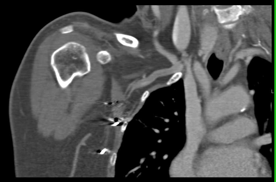 Occlusion of the Axillary Artery - CTisus CT Scan