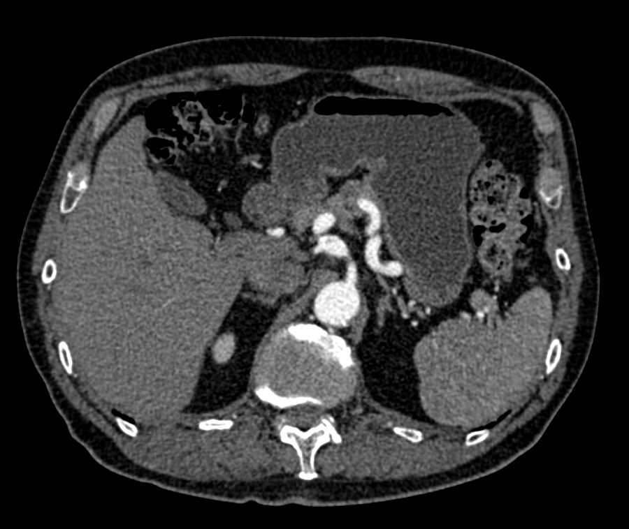 Multiple Aneurysms Including the Hepatic Artery and SMA - CTisus CT Scan