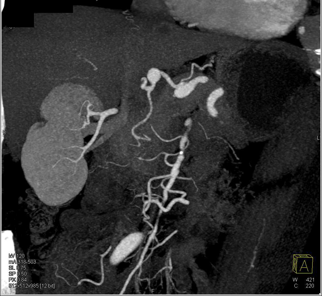 Multiple Aneurysms Including the Hepatic Artery and SMA - CTisus CT Scan