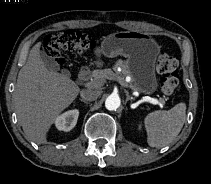 Multiple Aneurysms Including the Hepatic Artery and SMA - CTisus CT Scan