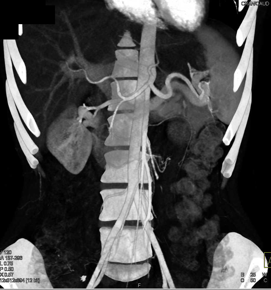 Superior Mesenteric Artery (SMA) Syndrome with Narrow SMA Angle - CTisus CT Scan