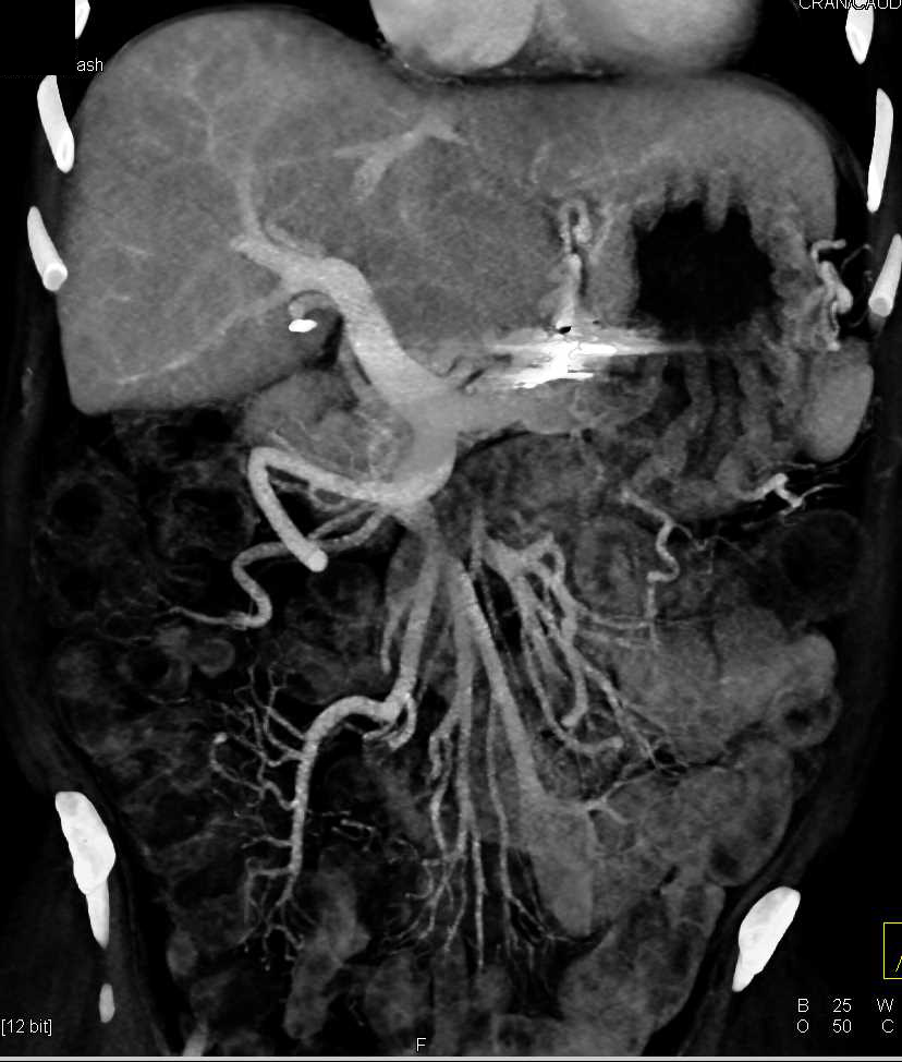 Mesenteric Vascular Disease - CTisus CT Scan