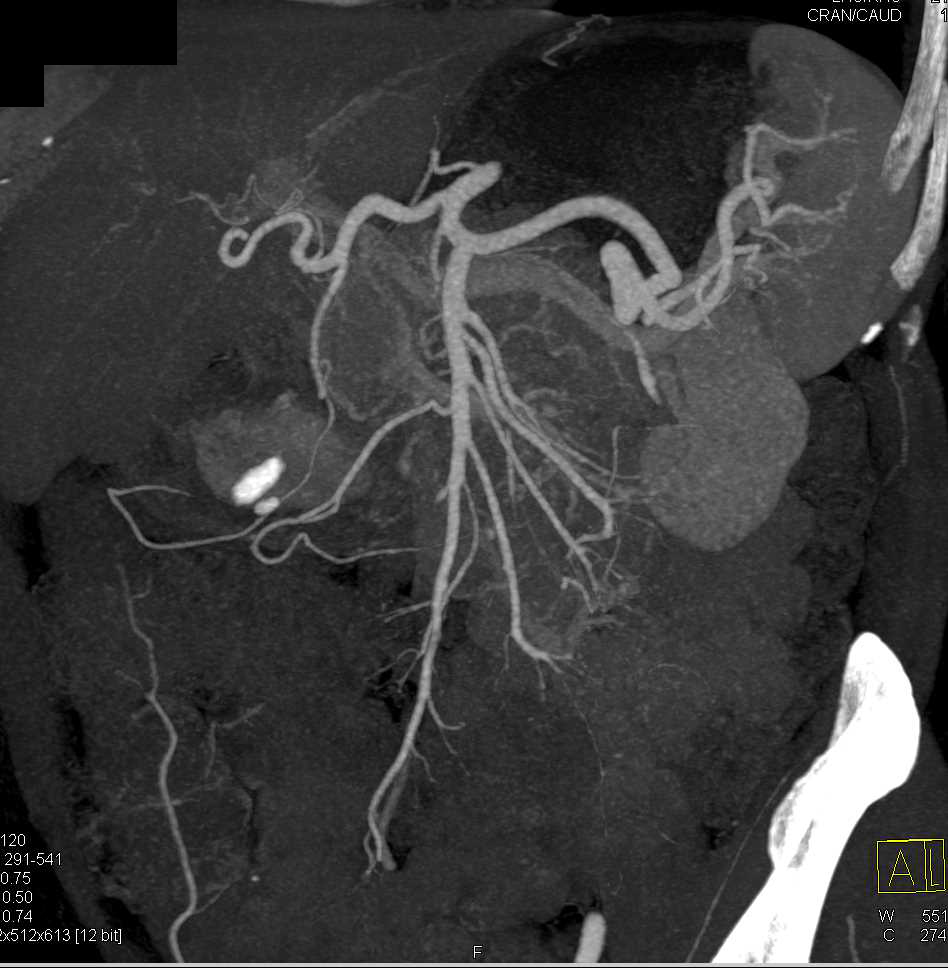 Thrombus in the Proximal SMA - CTisus CT Scan