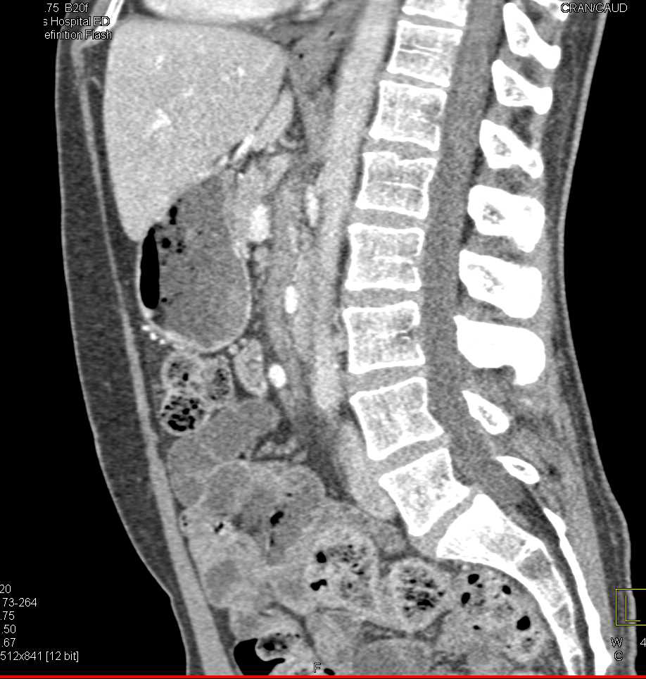 Thrombus in the Proximal SMA - CTisus CT Scan