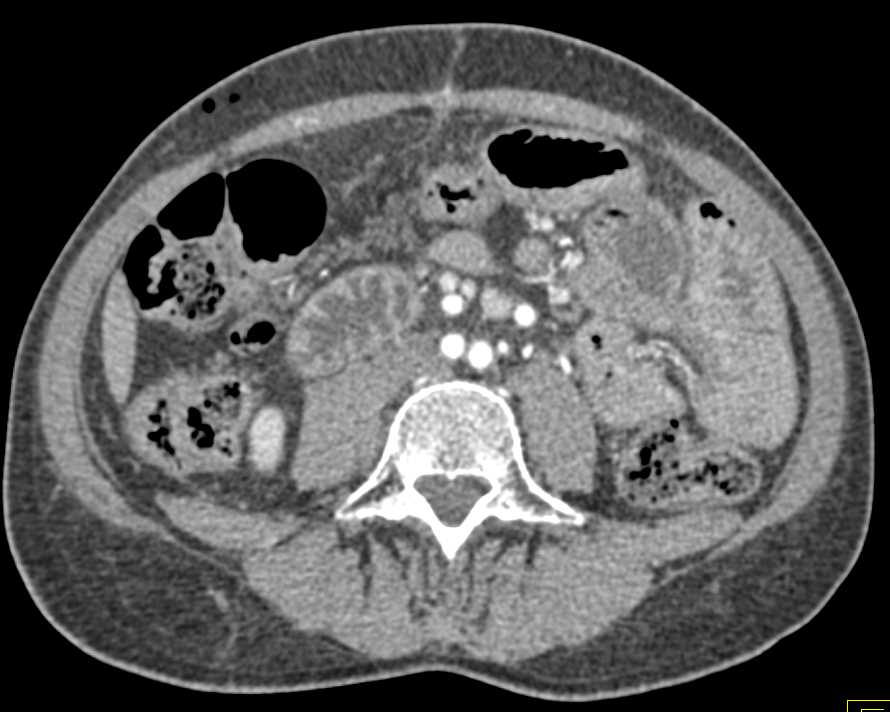 Thrombus in the Proximal SMA - CTisus CT Scan