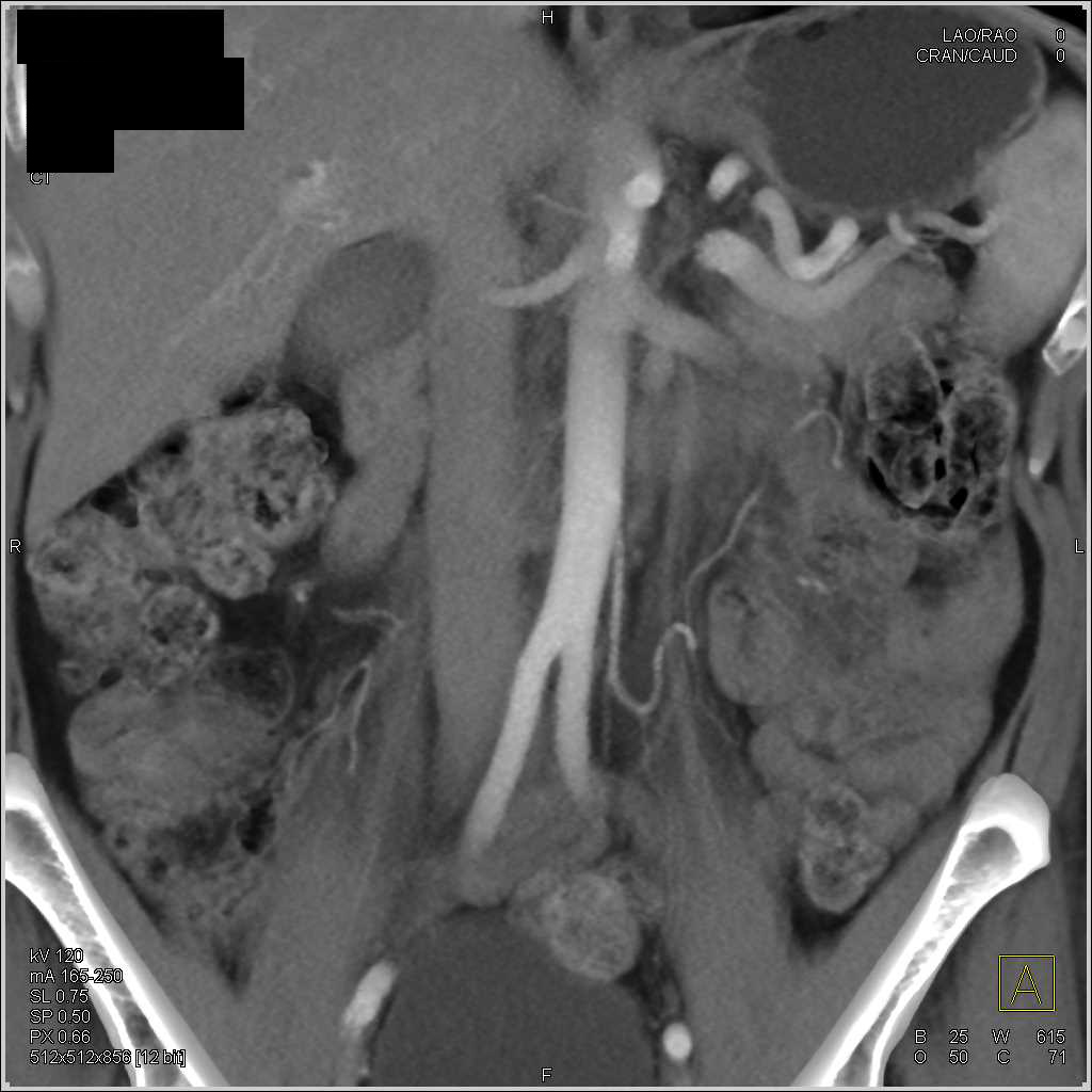 Vasculitis with Superior Mesenteric Artery (SMA) Involvement and Branches - CTisus CT Scan