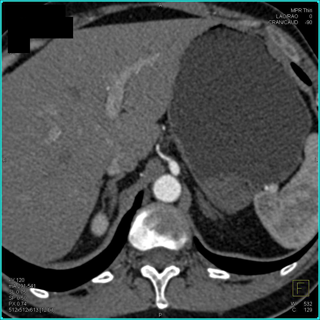 Vasculitis with Superior Mesenteric Artery (SMA) Involvement and Branches - CTisus CT Scan