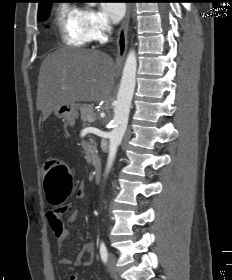 Celiac Stent in Patient with Median Arcuate Ligament Syndrome - CTisus CT Scan