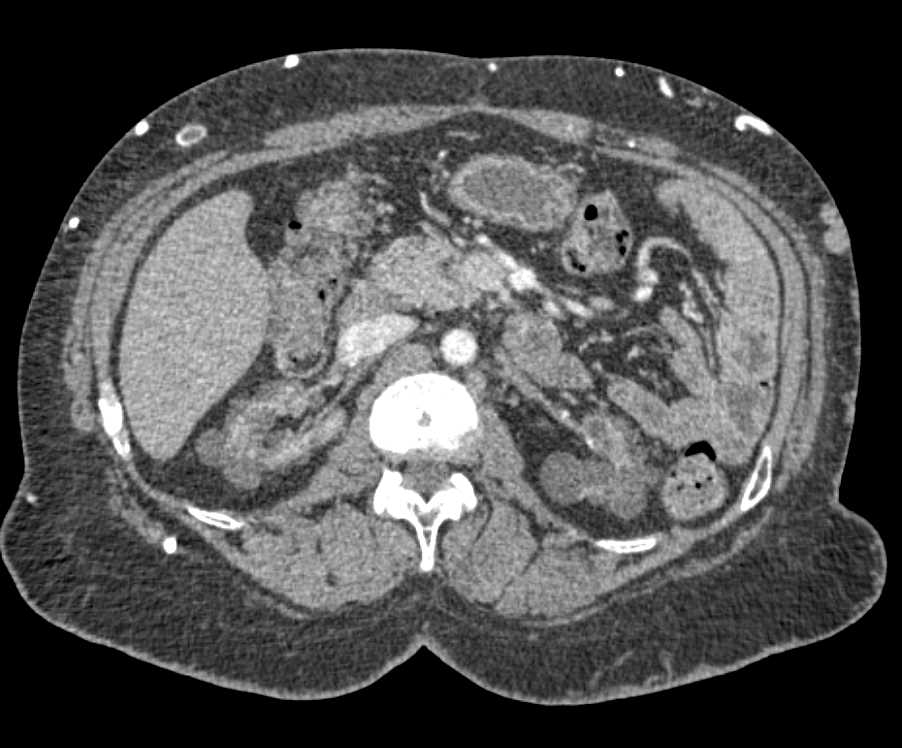 Arteriovenous (AV) Fistulae Left Thigh in a End Stage Renal Disease (ESRD) Patient - CTisus CT Scan