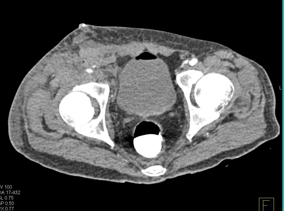 Extensive PVD (Peripheral Vascular Disease) - CTisus CT Scan