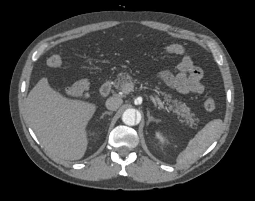 Aortic Dissection and Occlusion of Right Axillary Graft - CTisus CT Scan