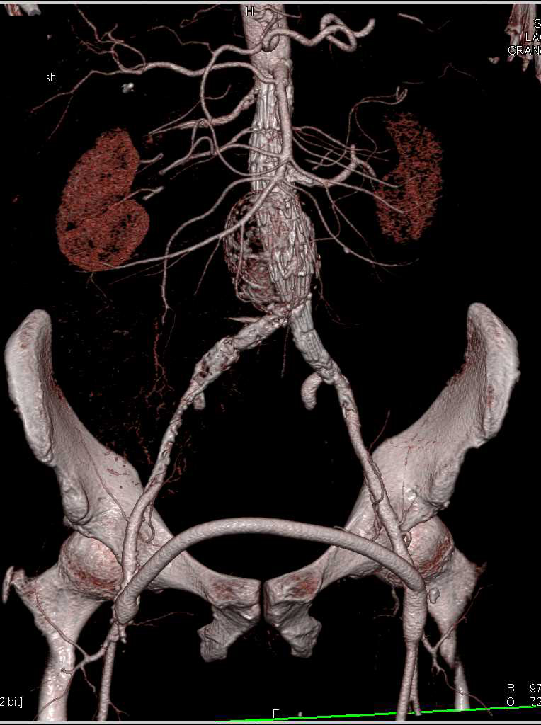 Patent Fem-Fem Bypass Graft - CTisus CT Scan