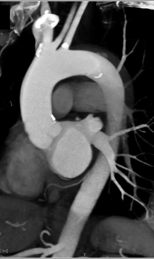 Intramural Hematoma - CTisus CT Scan