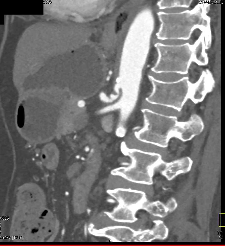 Median Arcuate Ligament Compression - CTisus CT Scan