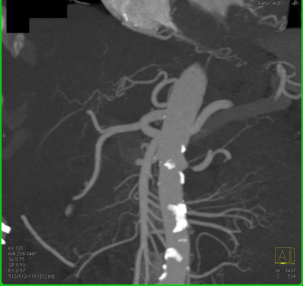 Critical Stenosis of the Left Renal Artery - CTisus CT Scan