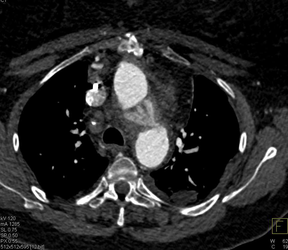 Type A Dissection with Repair and Reimplantation of the Coronary Arteries - CTisus CT Scan