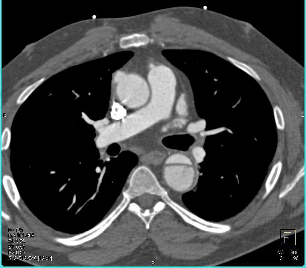 Aortic Dissection Extends down to the Renal Arteries - CTisus CT Scan