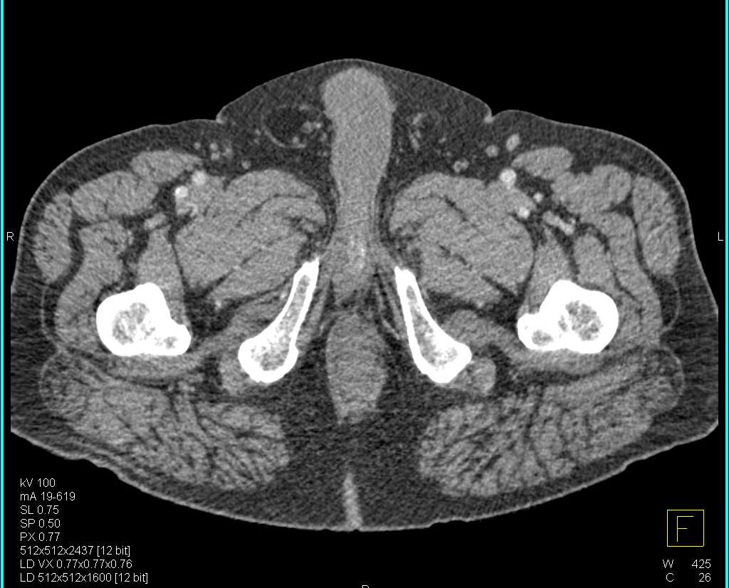 CTA Runoff with Peripheral Vascular Disease - CTisus CT Scan