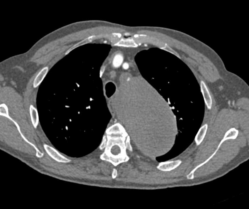 Type B Dissection with Stent Repair - CTisus CT Scan