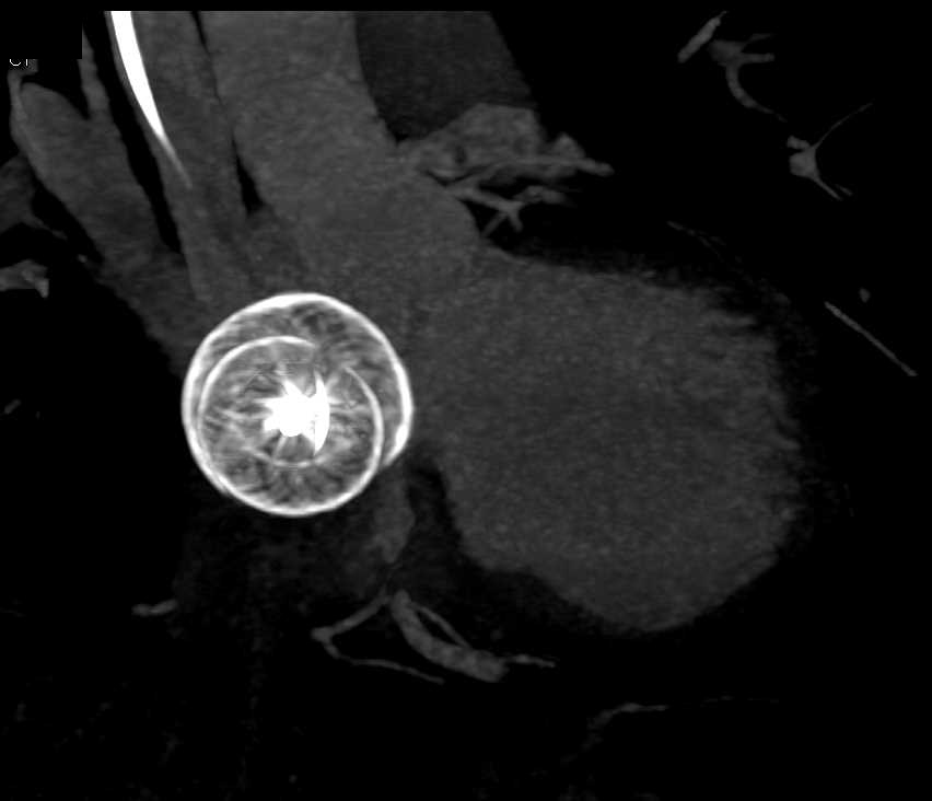 Amplantz Occluder for AV Connection - CTisus CT Scan