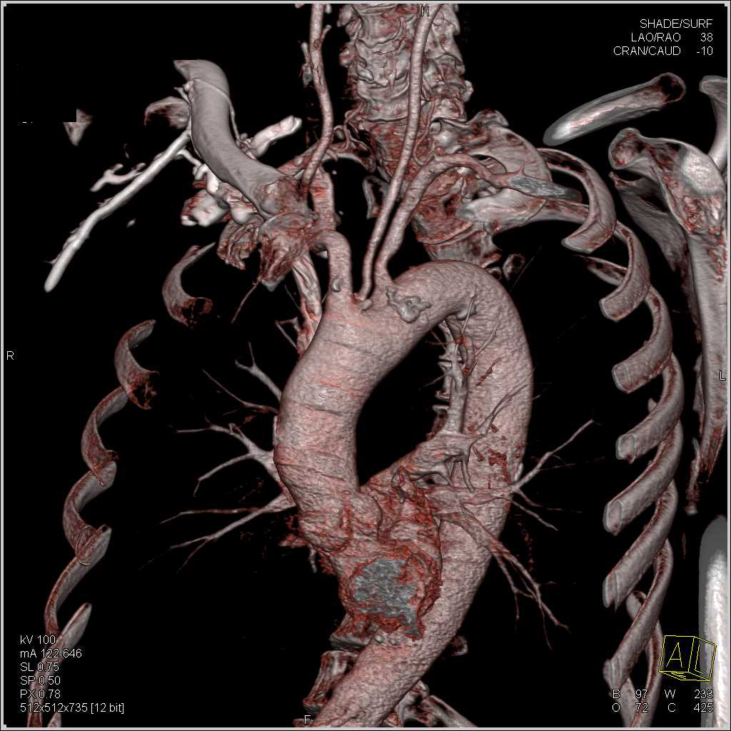 Atherosclerotic Disease in the Arch and Great Vessels - CTisus CT Scan