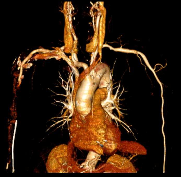 Pseudo Thrombus in Right Brachial Artery - CTisus CT Scan