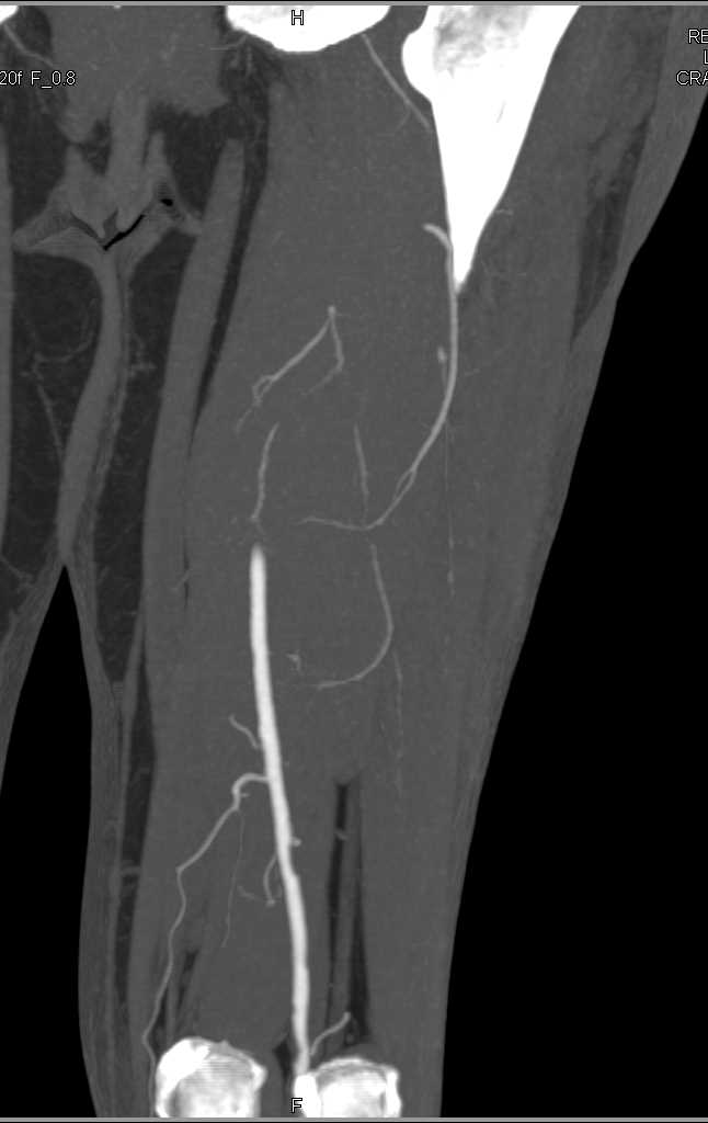 CTA with Plaque in the Popliteal Artery - CTisus CT Scan