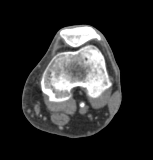 CTA with Plaque in the Popliteal Artery on Runoff Study - CTisus CT Scan