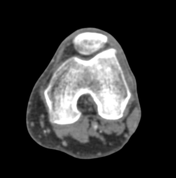 CTA with Plaque in the Popliteal Artery on Runoff Study - CTisus CT Scan