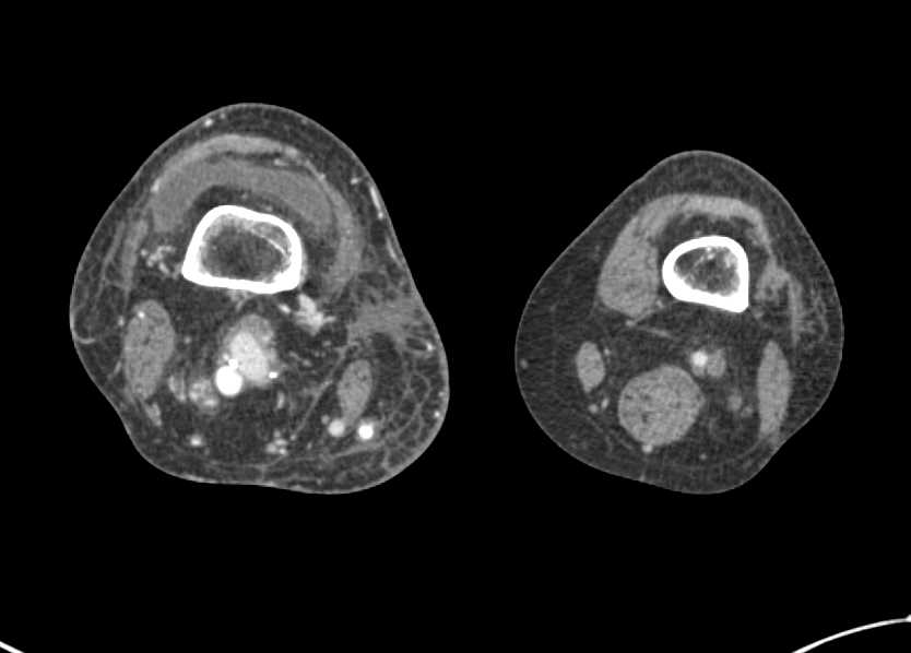 Enlarged Thigh with Arteriovenous (AV) Shunting and Arteriovenous Malformations (AVMs) - CTisus CT Scan