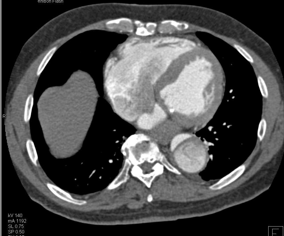 Type B Dissection - CTisus CT Scan