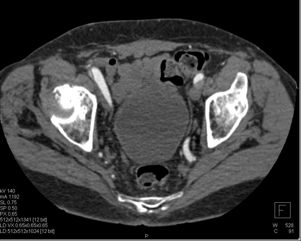 Type B Dissection Extends Down to the Left Femoral Artery - CTisus CT Scan