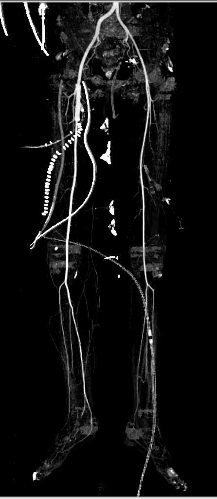 Focal Dilatation Right Superficial Femoral Artery (SFA) in Thigh - CTisus CT Scan