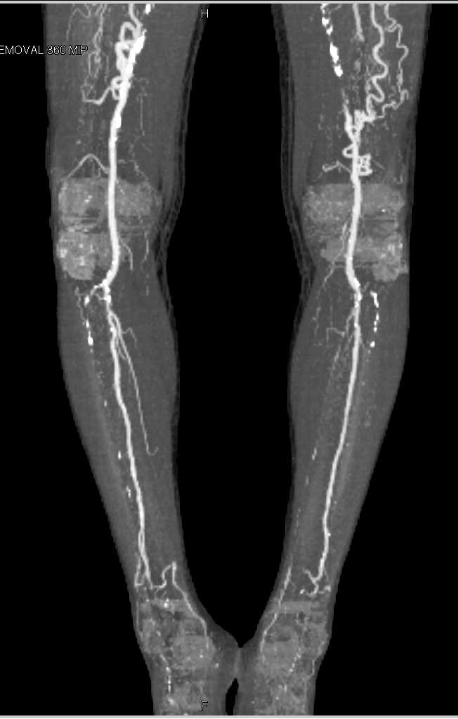 CTA with DE with Superficial Femoral Artery (SFA) Occlusion and Collaterals Bilaterally - CTisus CT Scan