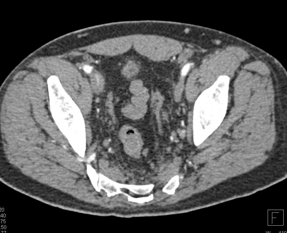 Recurrent Renal Cell Carcinoma with Encasement of the Inferior Vena Cava (IVC) - CTisus CT Scan