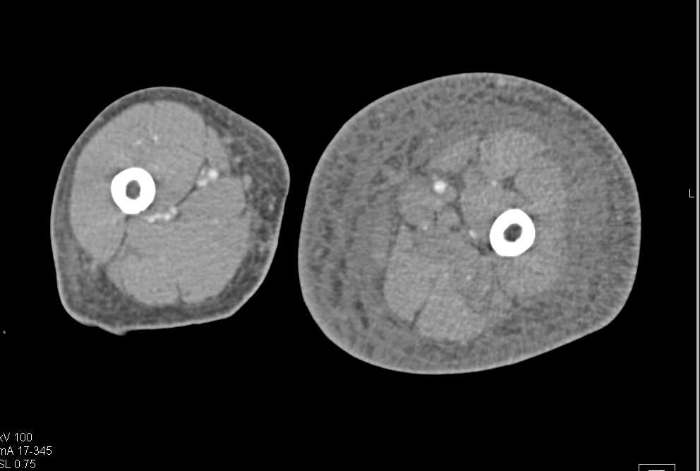 Lymphedema of the Thigh and Calf due to Vascular Occlusion - CTisus CT Scan