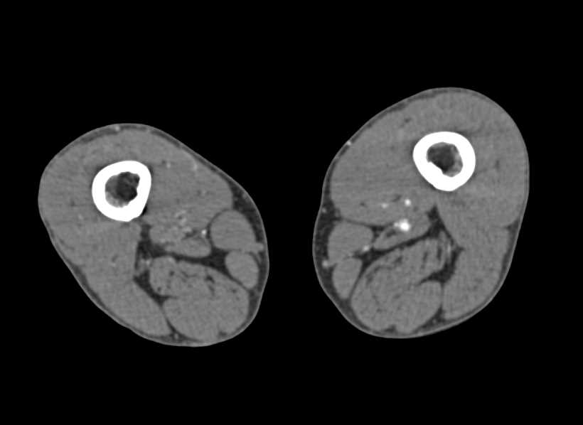 CTA Runoff with Occluded Stent in the Right Popliteal Artery - CTisus CT Scan