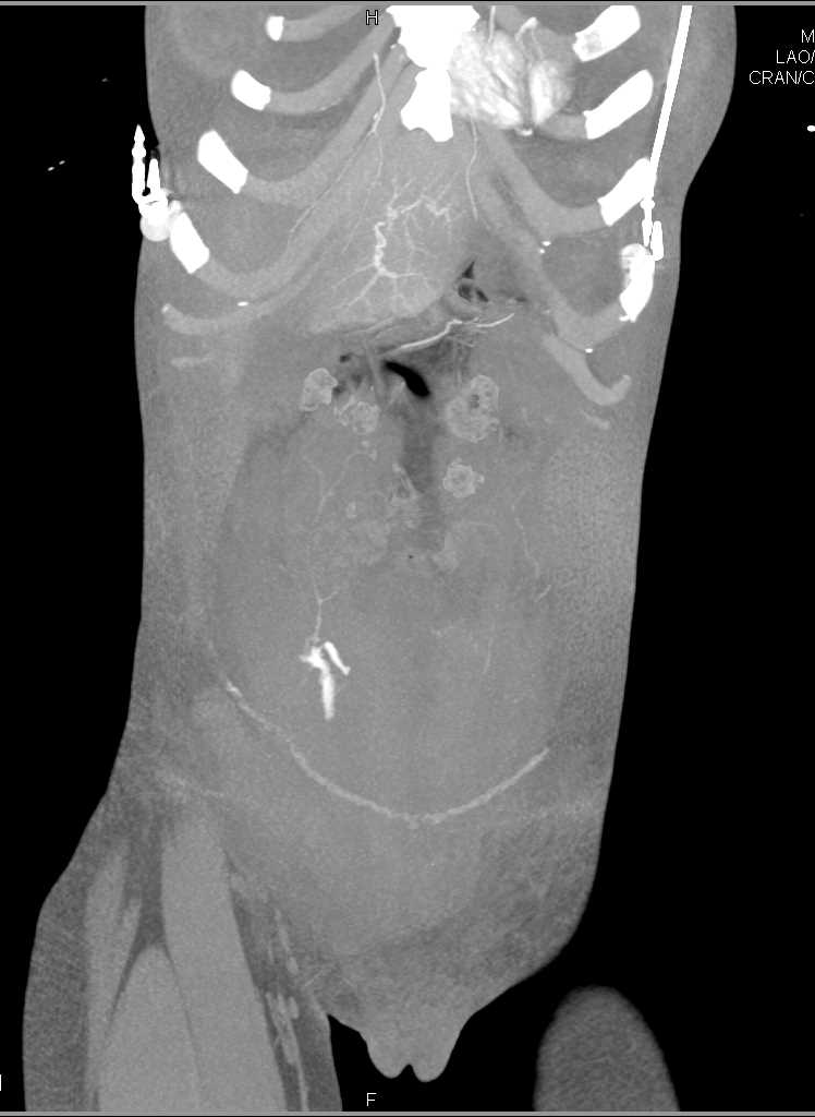 Active Bleed in Abdominal Wall Post Delivery - CTisus CT Scan